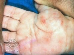 scabies palm